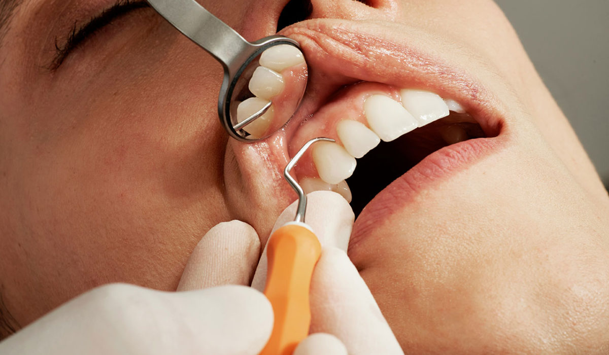Dentální hygiena: NAPADENT